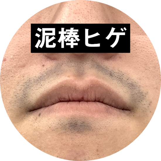 ヒゲ脱毛後の泥棒ヒゲの期間は約1週間解決方法を徹底解説 - ゴリラの医療脱毛コラム