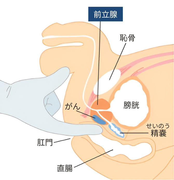 前立腺肥大症の手術体験① 手術のお勧め | ameba-imputのブログ