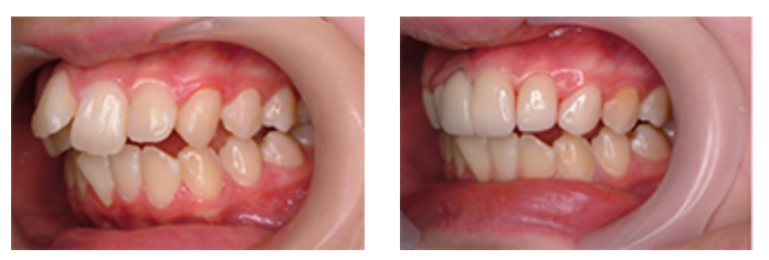 八重歯（やえば）、叢生（そうせい）ガタガタを抜かずに矯正？？
