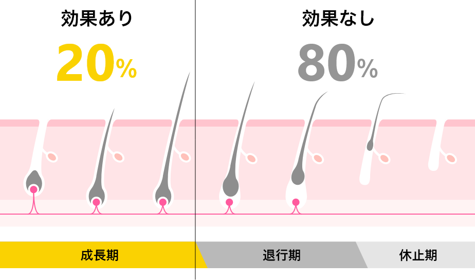 毛抜きでひげを抜くと | セルフ脱毛王