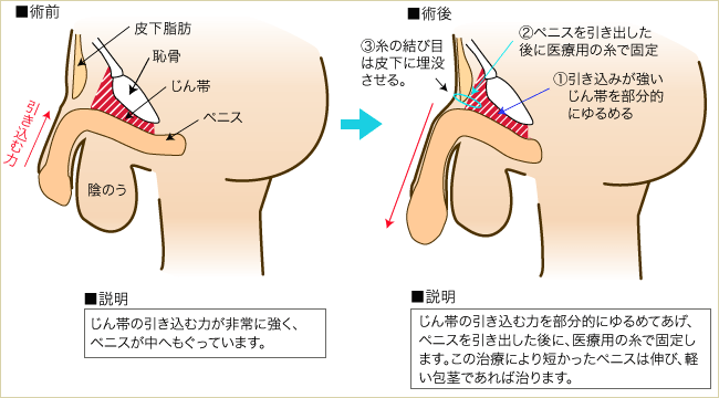 屈曲ペニス・湾曲ペニス修正手術-東郷美容形成外科 福岡メンズ｜福岡・博多で屈曲・湾曲ペニス・日本形成外科学会専門医が手術