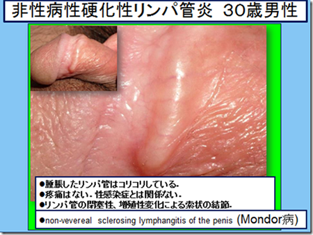 泌尿器科専門医 ドクター尾上の医療ブログ: 【性器の悩み】