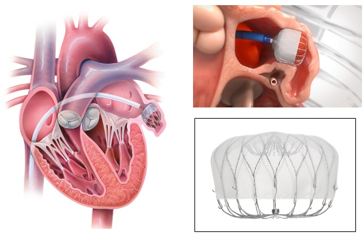 左心耳閉鎖デバイス WATCHMAN 植え込み術 詳細説明– 佐賀大学医学部循環器内科