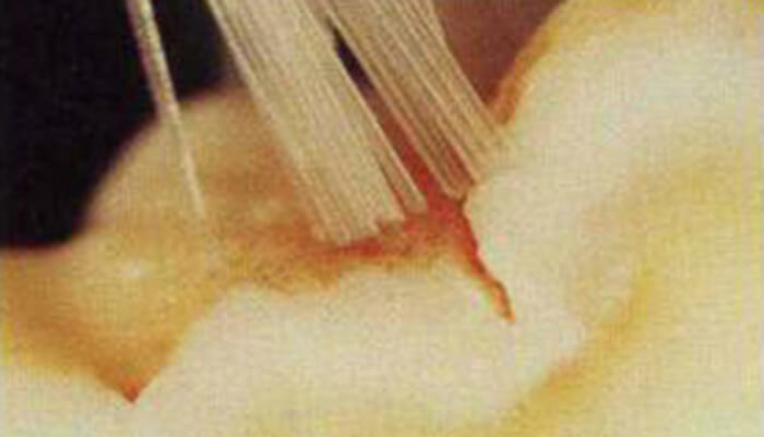 予防歯科 小窩裂溝とシーラント武蔵境 しらかば歯科