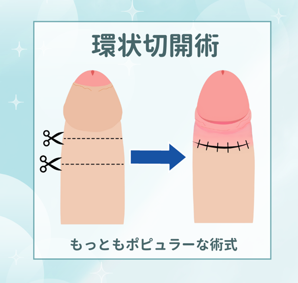 現役医師が解説】裏筋は性感帯じゃない！？ – メンズ形成外科 |