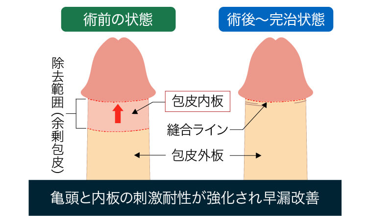 泌尿器科の専門医が解説】『亀頭が敏感な方』の原因と５つの治療法