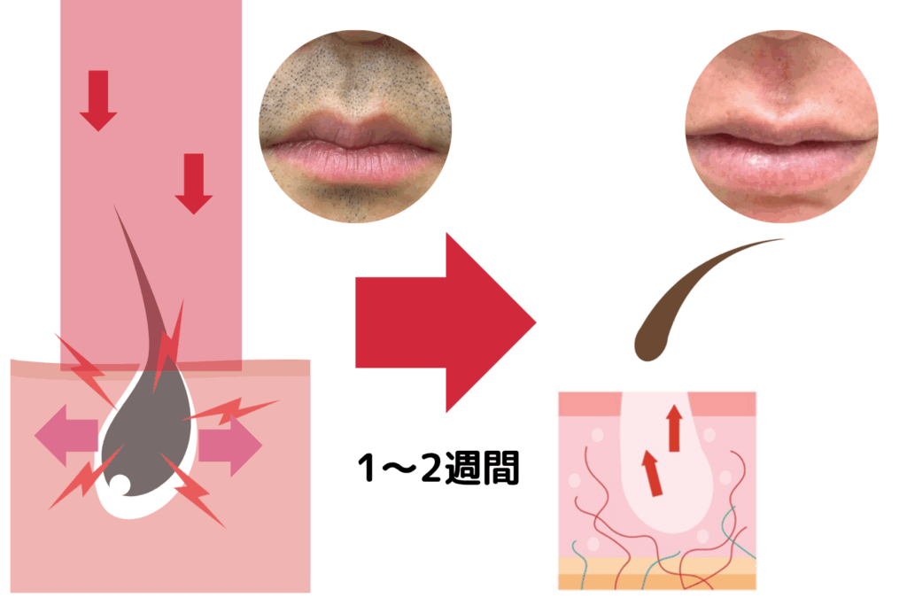 焦り禁物 髭脱毛後のどろぼうひげは剃れないって本当⁉原因と対策 - やってみたブログ