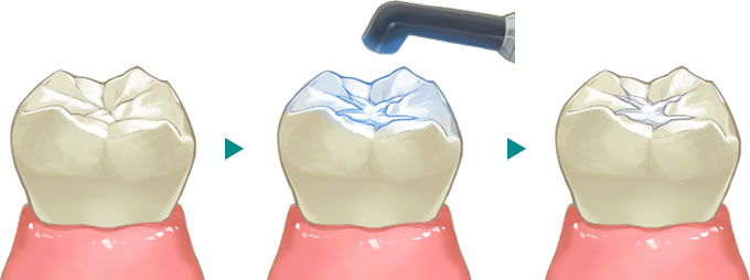 小児歯科学：シーラント 予防填塞計10問歯科医師国家試験2024年9月14日更新DENTAL YOUHT