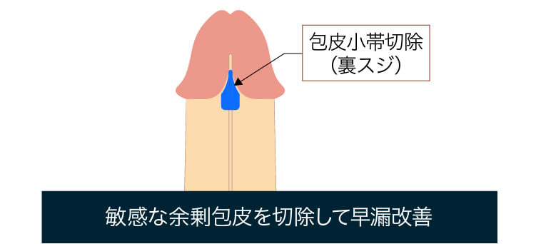 包茎の亀頭の赤みは自分で治せる！？ | ネオ形成外科