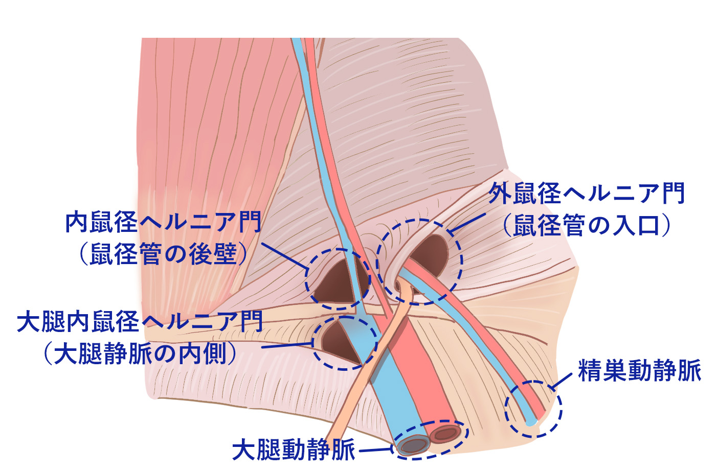 特に女性で、足の付け根（鼠径部）のリンパ節が腫れて痛む原因には何がありますか？ ｜股関節痛