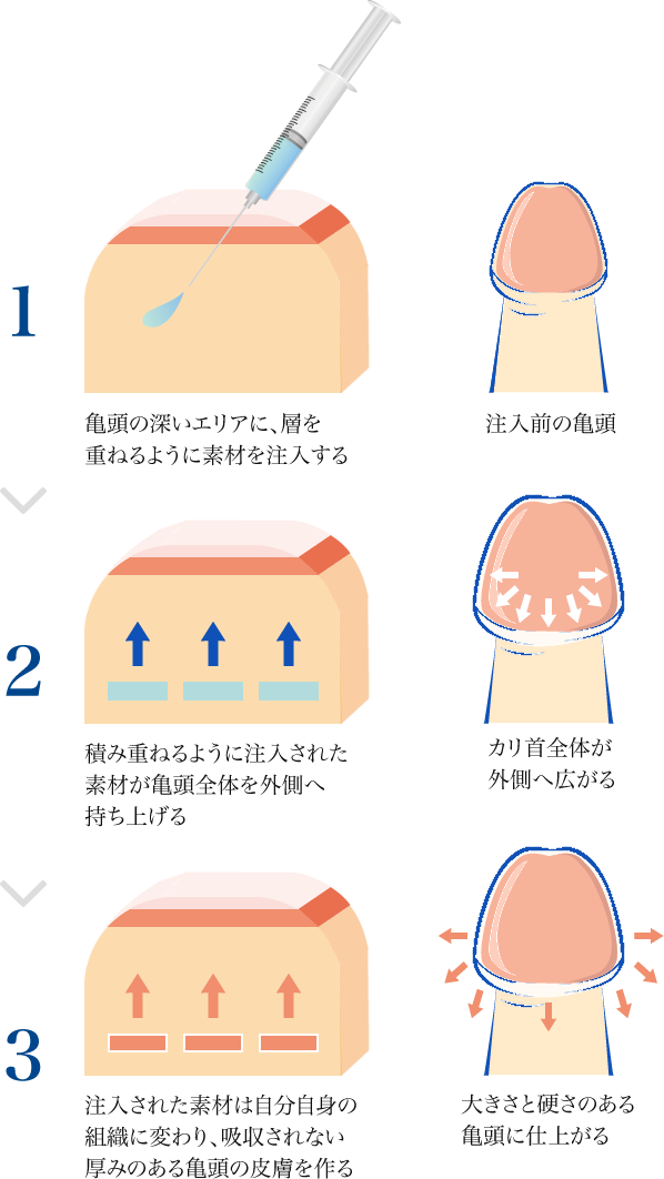 亀頭包皮炎は自然治癒する？|『治すための方法』と『病院に行くべきタイミング』を解説 | 泌尿器科｜GOETHE