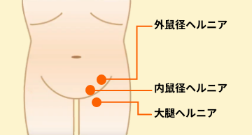 鼠径ヘルニアの治療｜外科・消化器外科｜診療科・部門｜湘南慶育病院