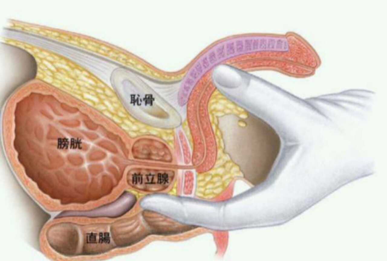 慢性前立腺炎｜神戸市東灘区 摂津本山｜いしむら腎泌尿器科クリニック