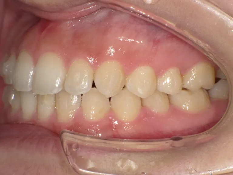 Qoo10ブリリアント モア ブリリアントモア ダブル 90g 1個 : 日用品雑貨