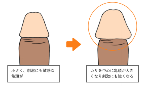 泌尿器科の専門医が解説】『亀頭が敏感な方』の原因と５つの治療法