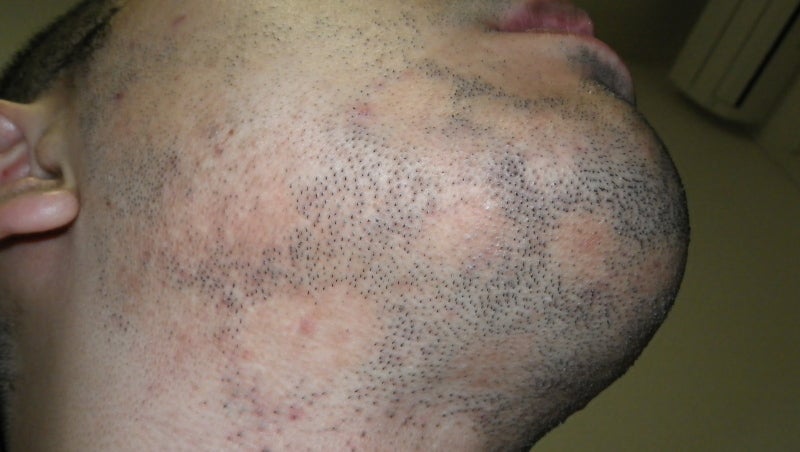 泥棒ヒゲについて 公式 男性脱毛のメンズリゼ