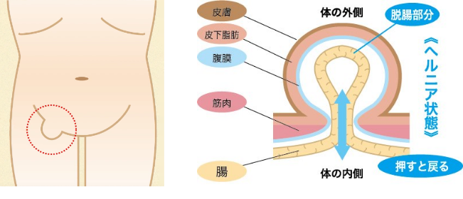 鼠径ヘルニア | 宮城県大崎市 北みやぎ外科クリニック