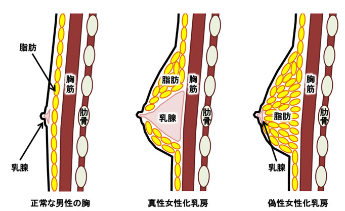 女性化乳房とは【原因・見分け方・治し方】男性の乳房肥大